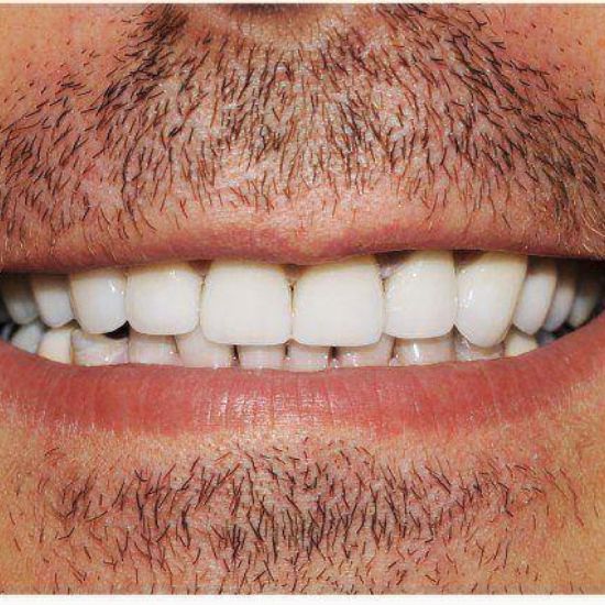 dental-crown-restore-smile-after-great-bookham-dental-practice