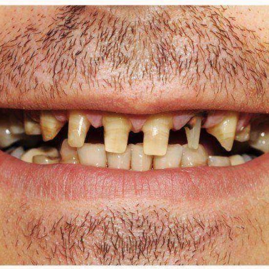 dental-crown-restore-smile-before-great-bookham-dental-practice