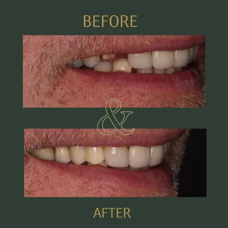 Before and after results of dental implant treatment at Great Bookham Dental Practice