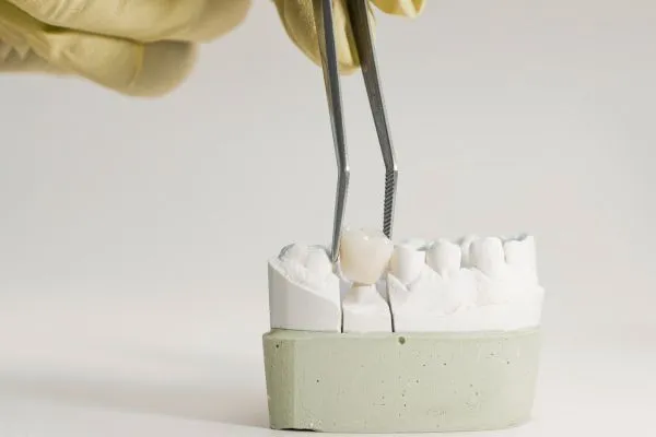 great bookham dental what is dental crown